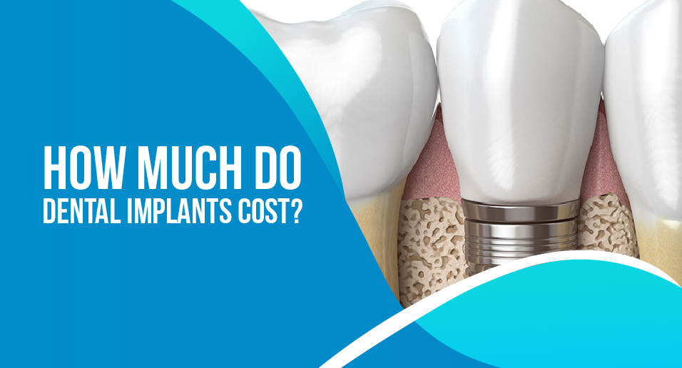 How Much Do Dental Implants Cost?