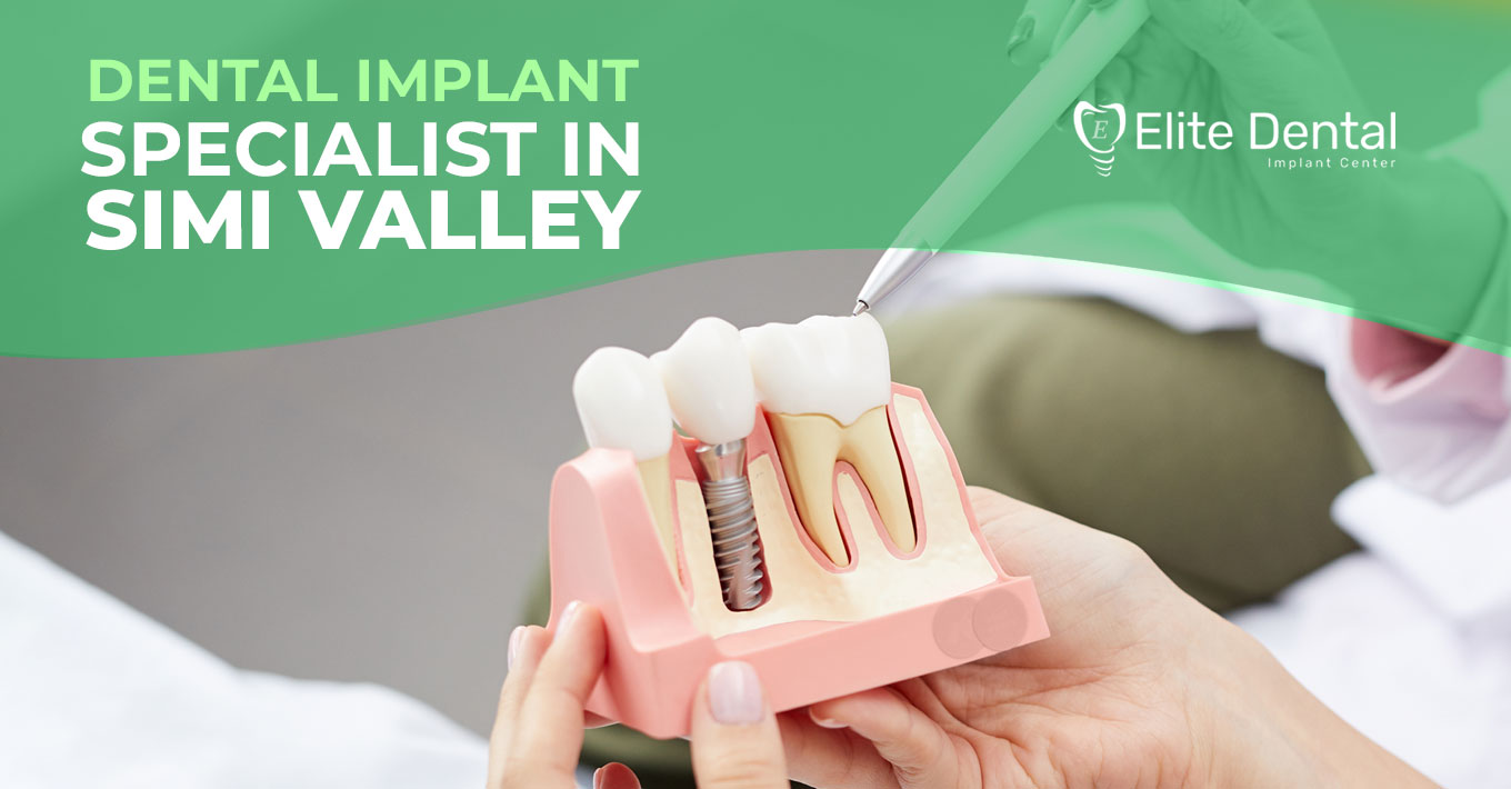 Dental Implants Simi Valley Dental Services